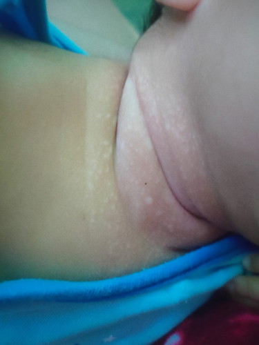 Puti sa leeg ni baby
