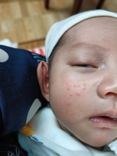 Bé nhà m bị mụn như này thì bôi cái gì cho khỏi ạ ?