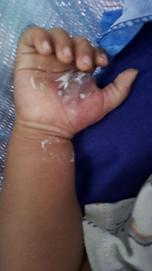 Bentol berisi cairan