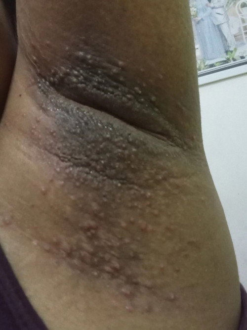 Ketiak perih dan bruntusan