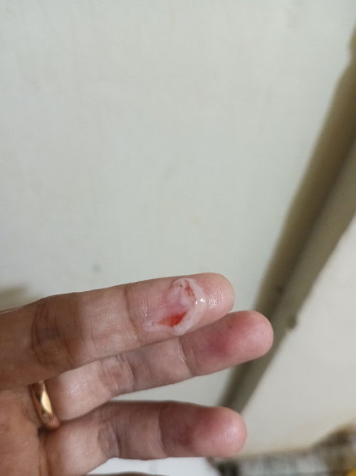 BERCAK DARAH DIKEPUTIHAN