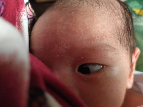 Ano po kaya tong rashes ng baby ko sa mukha?