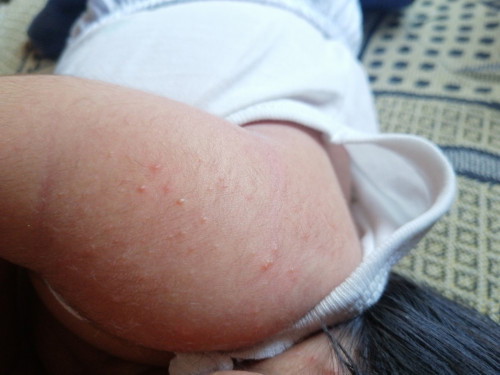 butlig2 sa katawan at mukha ni baby (15days old)