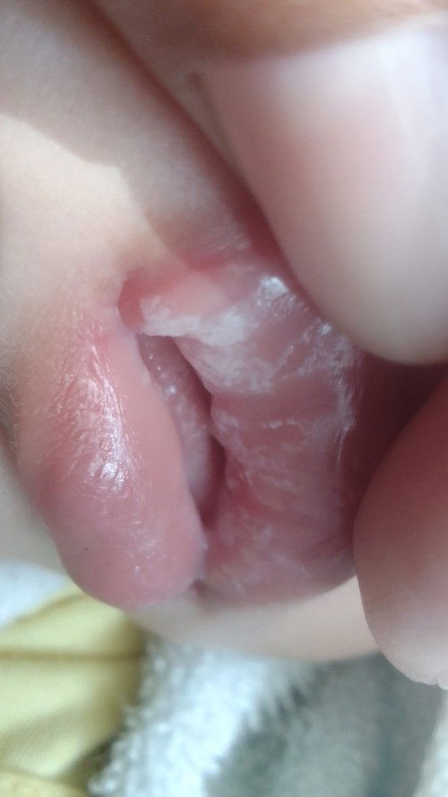 Có bị j k các mẹ, bé nhà e sốt 2 ngày muk chưa khỏi