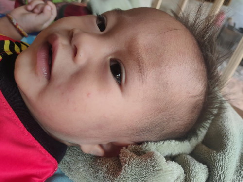 อาการส่าไข้