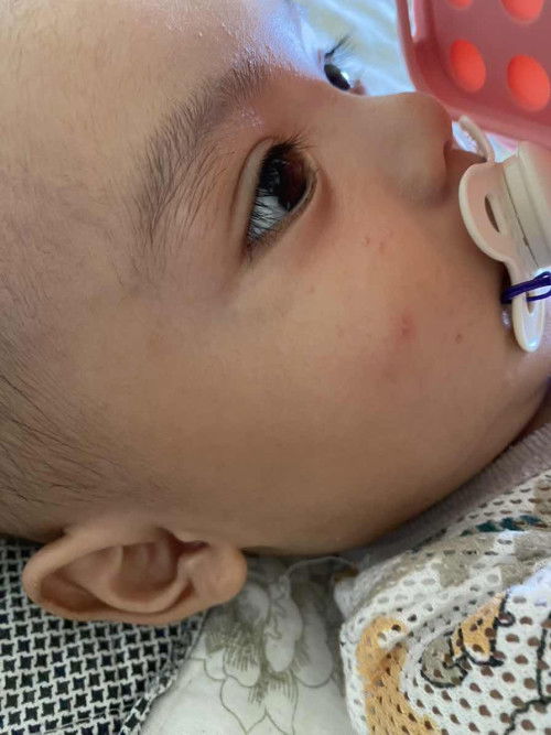 RUAM DI BAHAGIAN MUKA SAHAJA