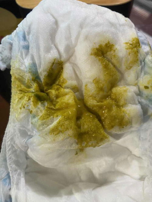 Plema sa popo ng baby