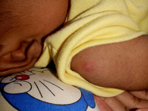 Benjolan ditangan & bruntus diperut