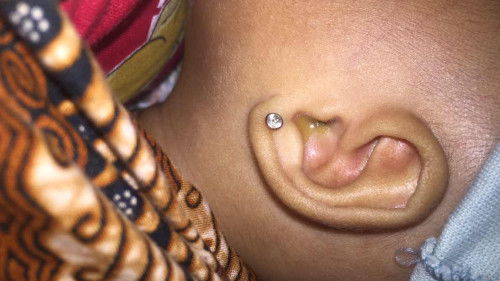 Telinga mengeluarkan air kuning dri telinga