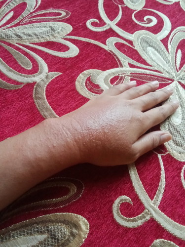 Rashes sa kamay