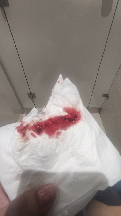 Blod Clot sa Stool. 1st pregnancy, 9 weeks.