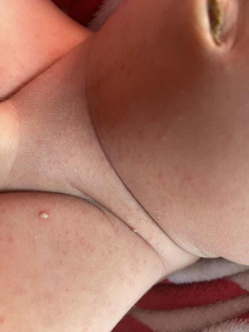 ผื่นเต็มตัวทารก