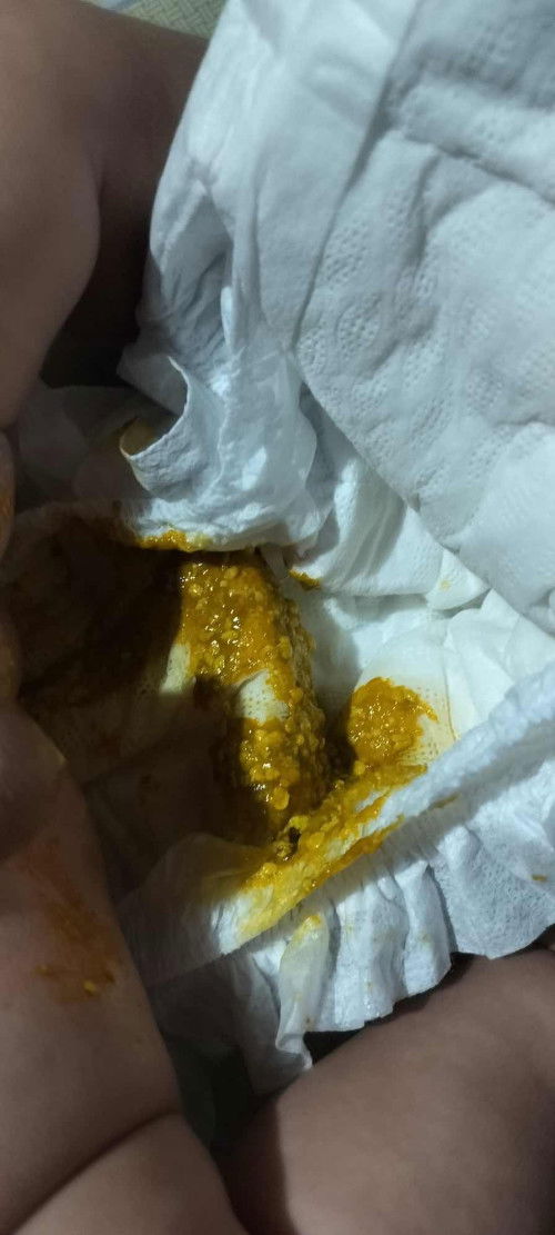 Không dung nạp đường Lactose