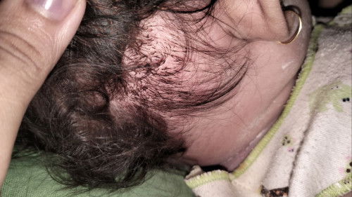 Penyebab gatal di rambut bayi