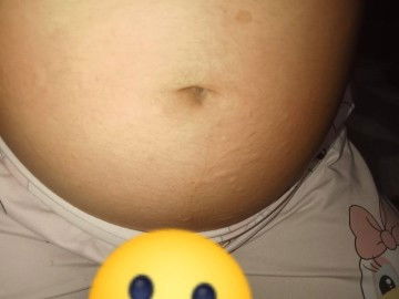 เป็นลมพิษตอนตั้งครรภ์