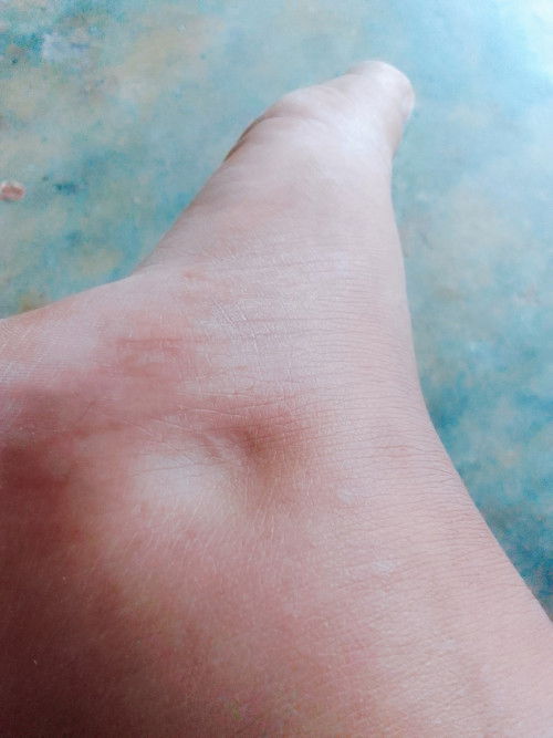 ท้องแข็ง+มือ เท้า หน้าบวมกดแล้วบุ๋ม