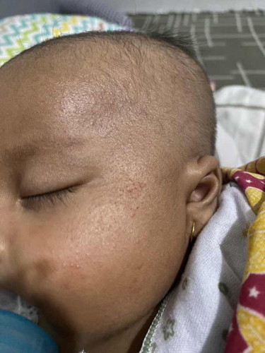 Bruntusan diwajah bayi