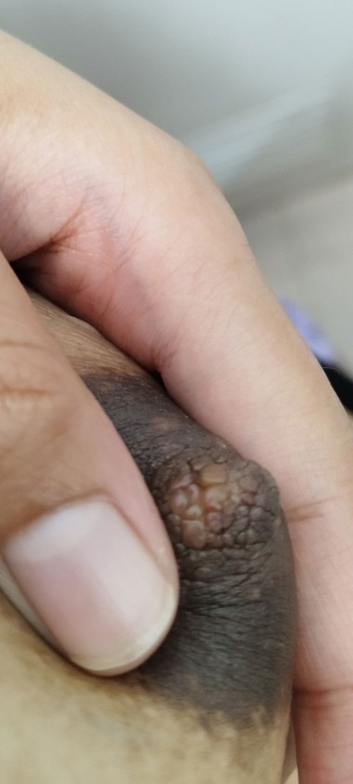 Nipole sore due to pumping