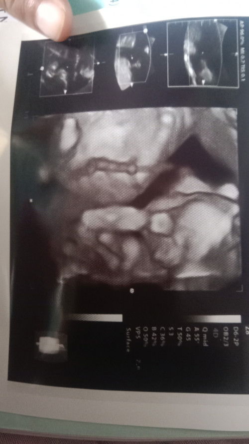 Alhamdulilah bun aku td usg hasilnya bagus semua