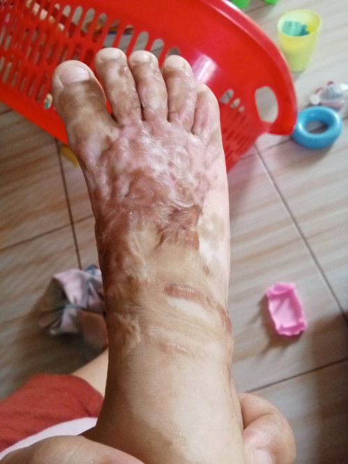 Muncul keloid gimana cara hilangkan nya