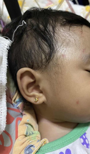 Red dots sa mukha