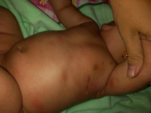 Bayi 2 bulan kena bercak-bercak seperti cacar air