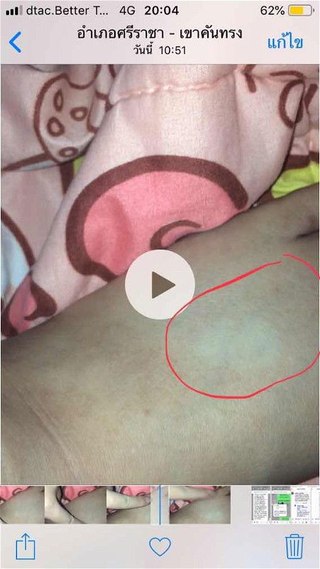 เท้าบวมกดแล้วเป็นแบบนี้บุ๋มมั้ยคะ