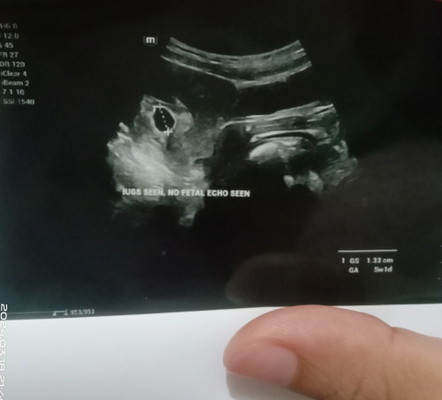 Pergi scan 6w 2d cuma nampak kantung sahaja btw ukuran kantung 5w 1d