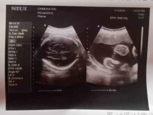 Ultrasound