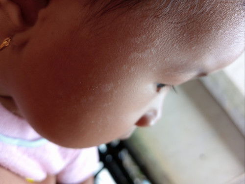 cara menghilangkn putih" seperti panu