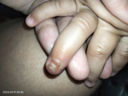 Kejepit pintu anak 15bulan