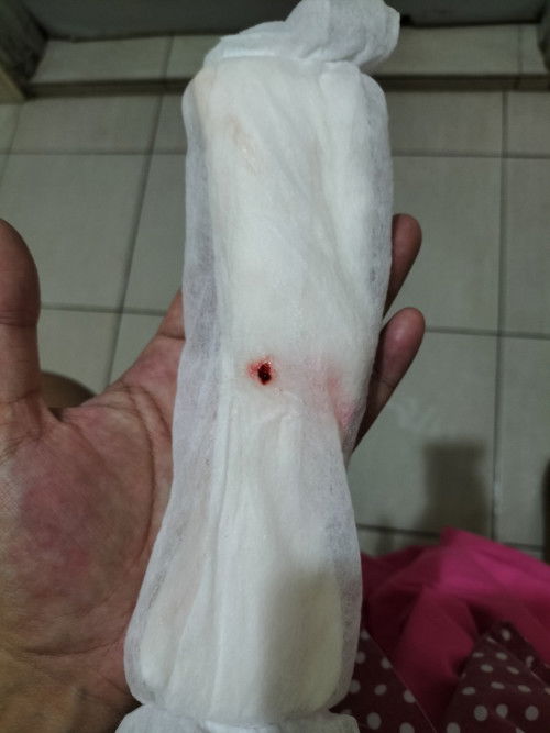 อายุครรภ์33วีค5วัน มีอาการน้ำเดิน แต่ไม่เจ็บท้องคลอด