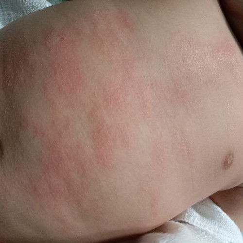 Ruam dan kulit kering