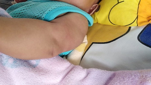 ลูก2เดือน10วันค่ะมีผื่นตุ่มเล็กๆเต้มทำยังไงจะหายคะ
เกี่ยวกับเพราะเปลี่ยนน้ำยาซักผ้ารึป่าวคะ