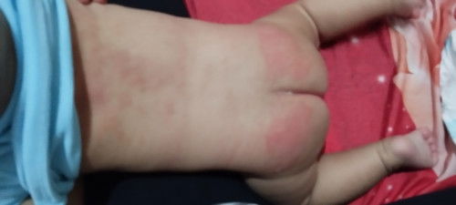 Bund yang anaknya pernah kaya gini pake apa ya biar cepet ilang, udh pake merk mama choice merk