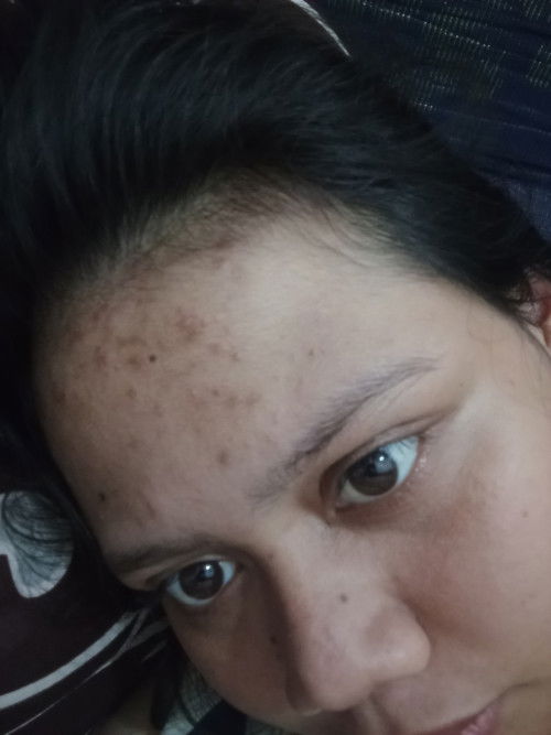 Jerawat dan bekas Luka di wajah