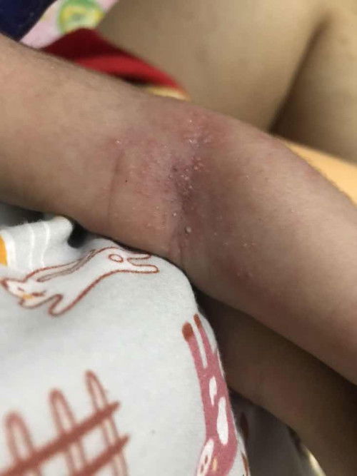 tanya bintik" di kulit bayi newbron