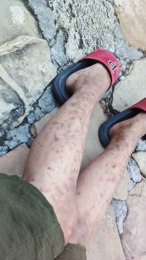 Kulit kentang sensitif