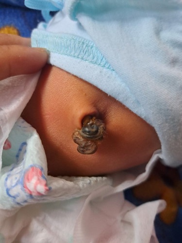 Pusod ng newborn