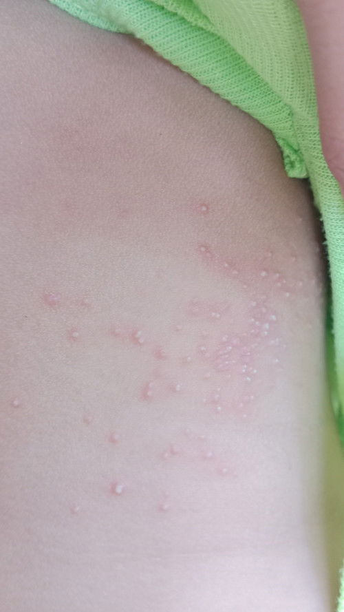 Bayi 7 bulan gatal gatal