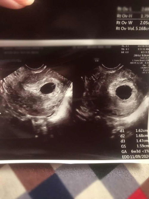 Blighted Ovum? LMP 01/13/24
6wks & 3days Empty Gest. Sac