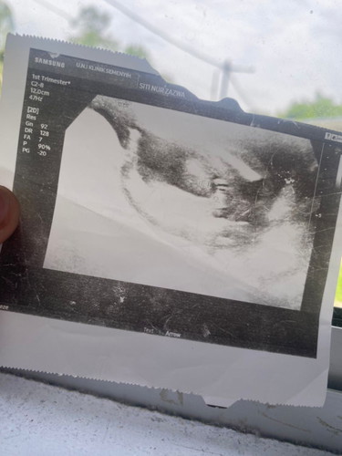 Gender baby