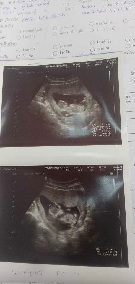 ท้องแรกแฝดไข่ใบเดียวกัน