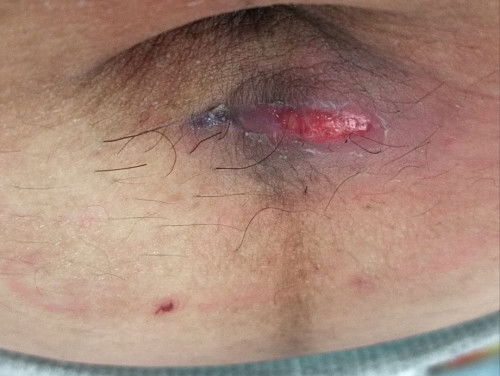 แผลทำหมันขยายเป็นรอยแตก