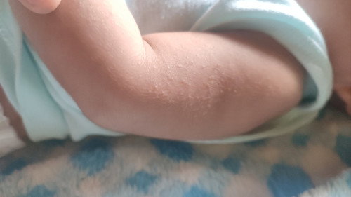 Bintik di tangan dan wajah