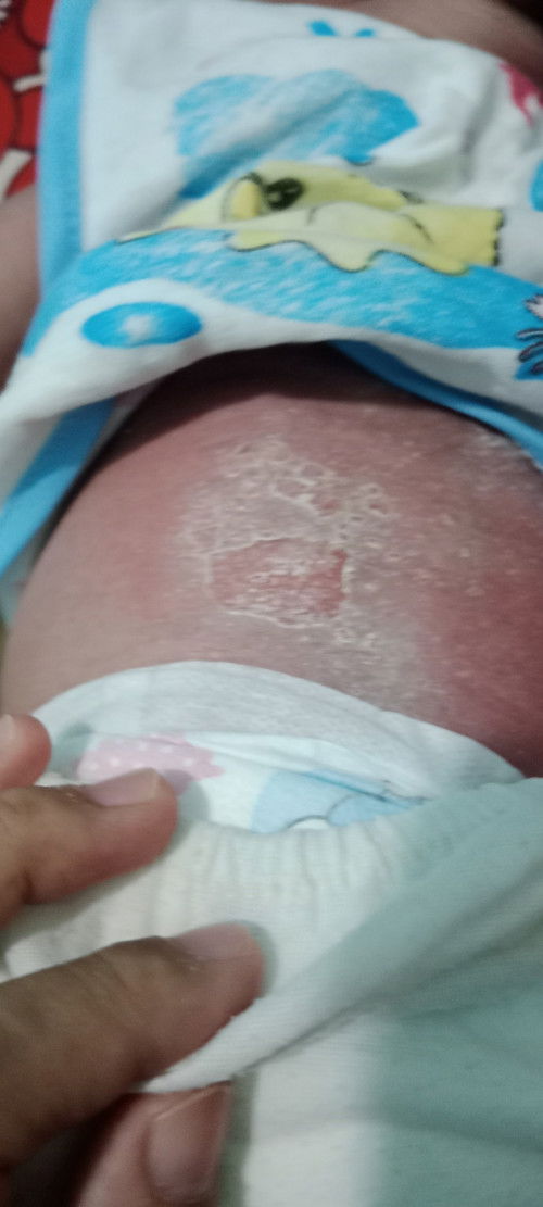 Ruam/merah di sepanjang badan belakang