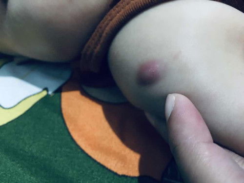 Benjolan bekas imunisasi