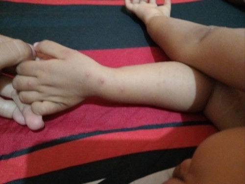 Seperti biang keringat tapi ada Kya nanah