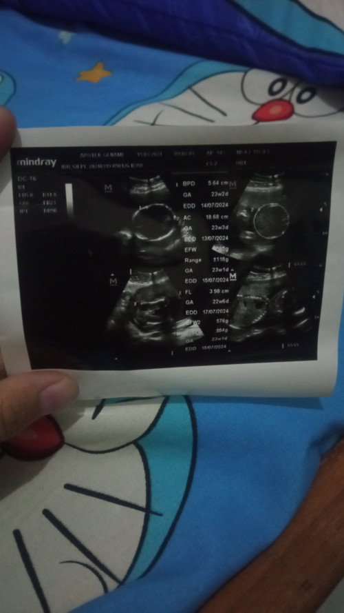 Hasil USG Kehamilan pertama (5 bulan)