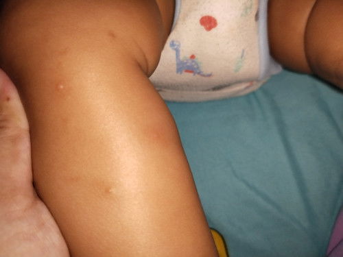 bintik bintik di tangan dan kaki